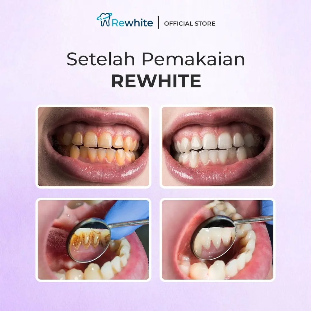 Setelah pemakaian Rewhite - hasil before after gigi lebih putih bersih